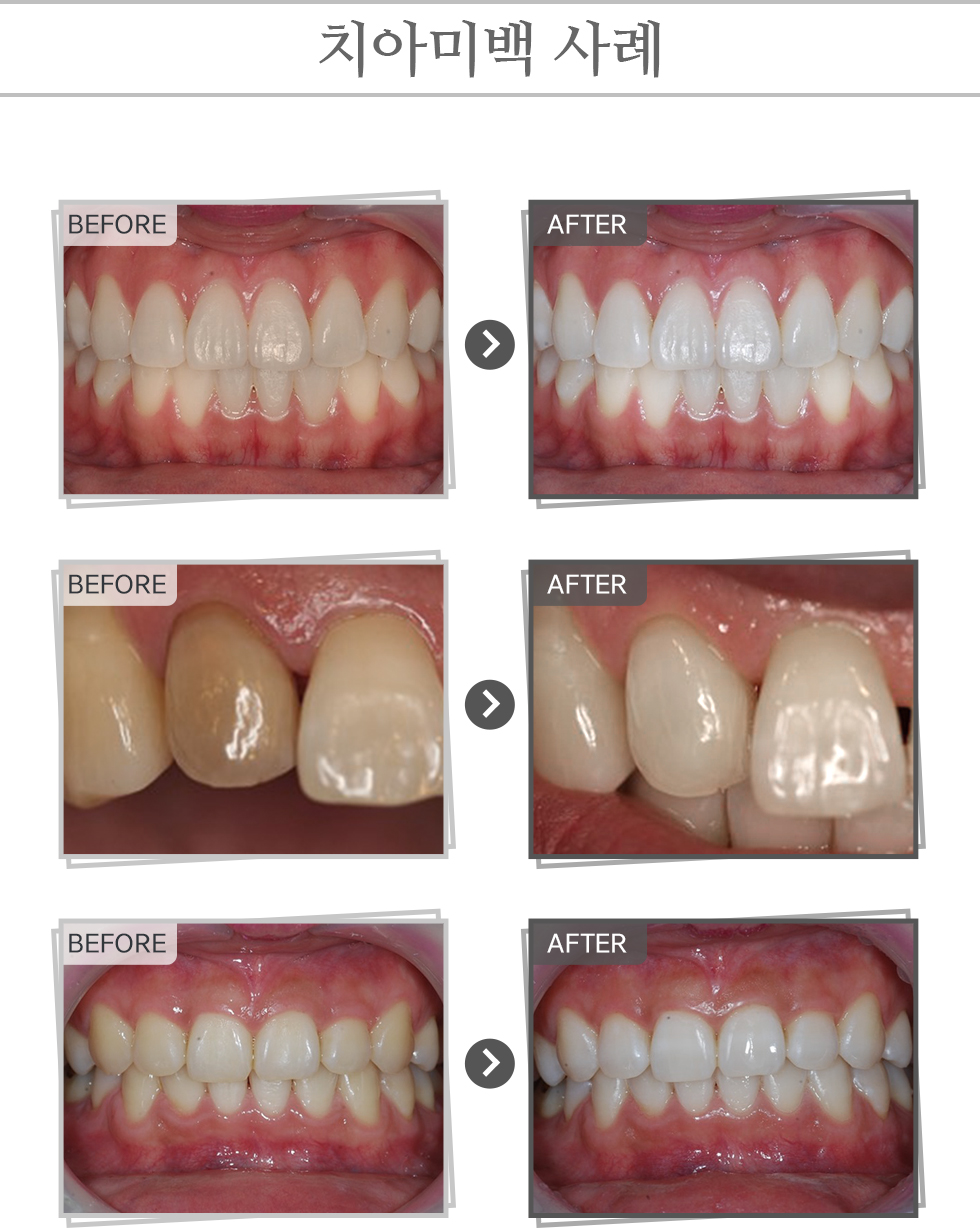 치아미백 사례
