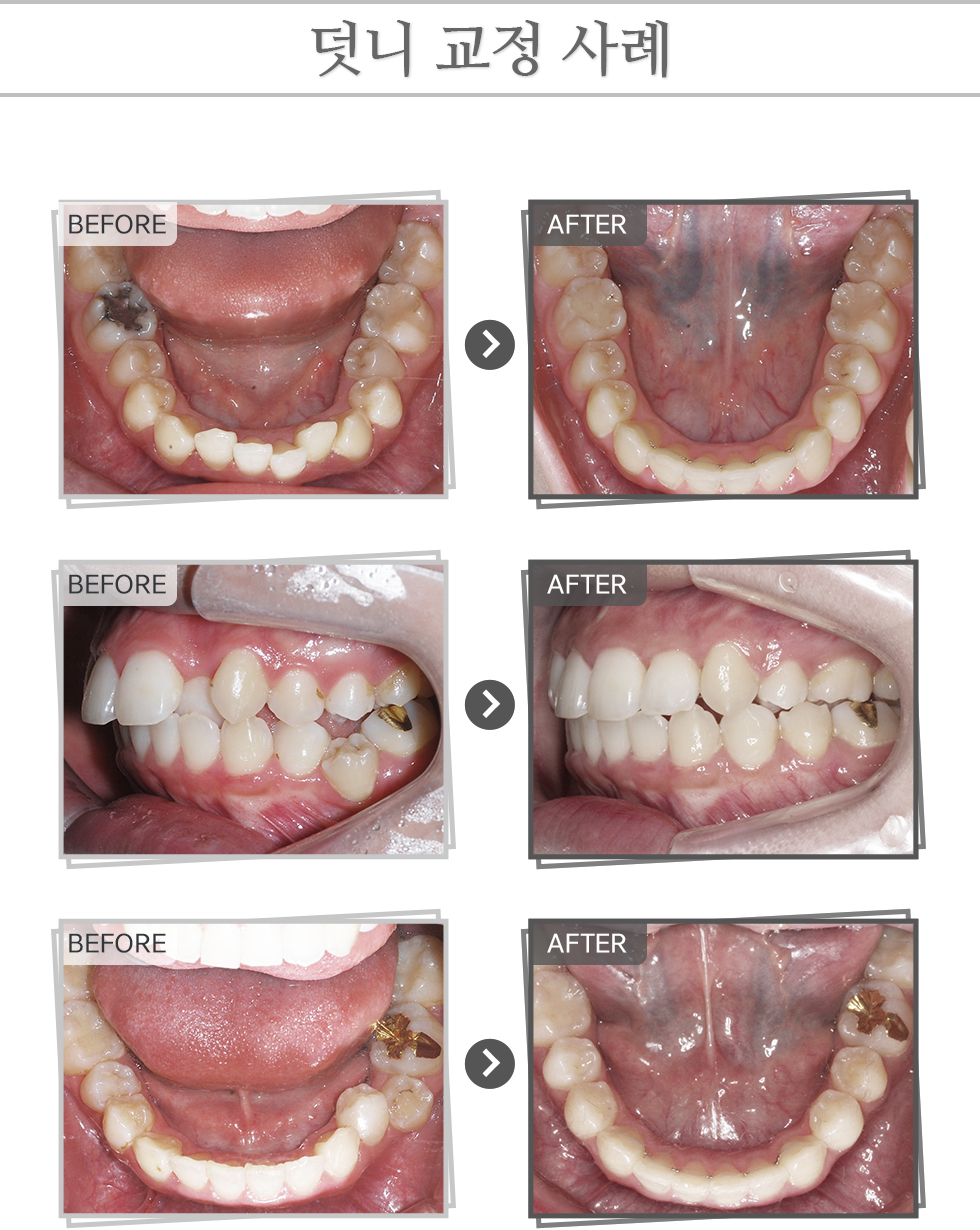 덧니 교정 사례