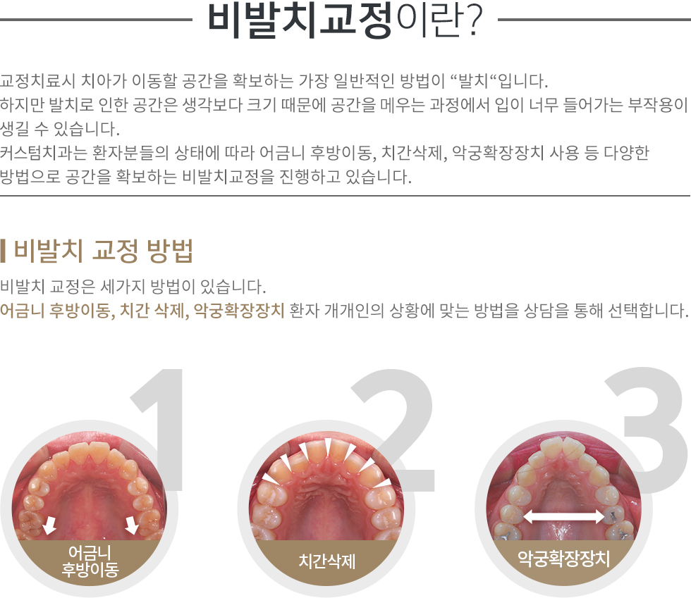 비발치교정이란?