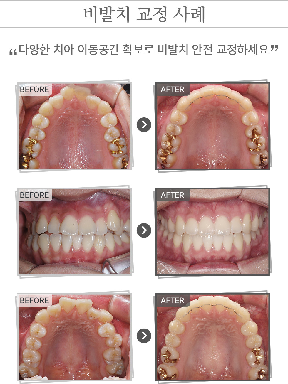 비발치교정 사례